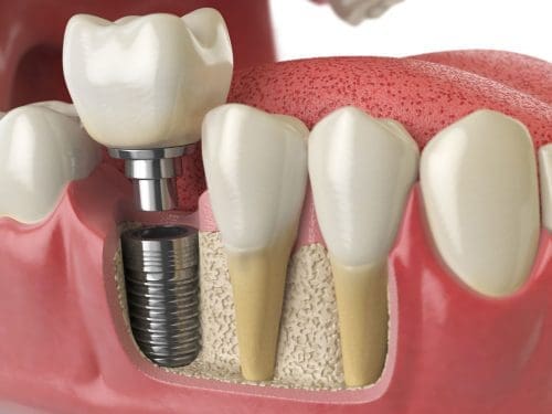 Animation of dental implant.