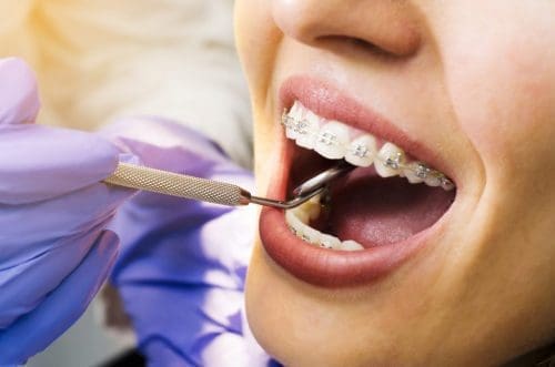 Dentist holds mirror tool in patients with braces mouth.