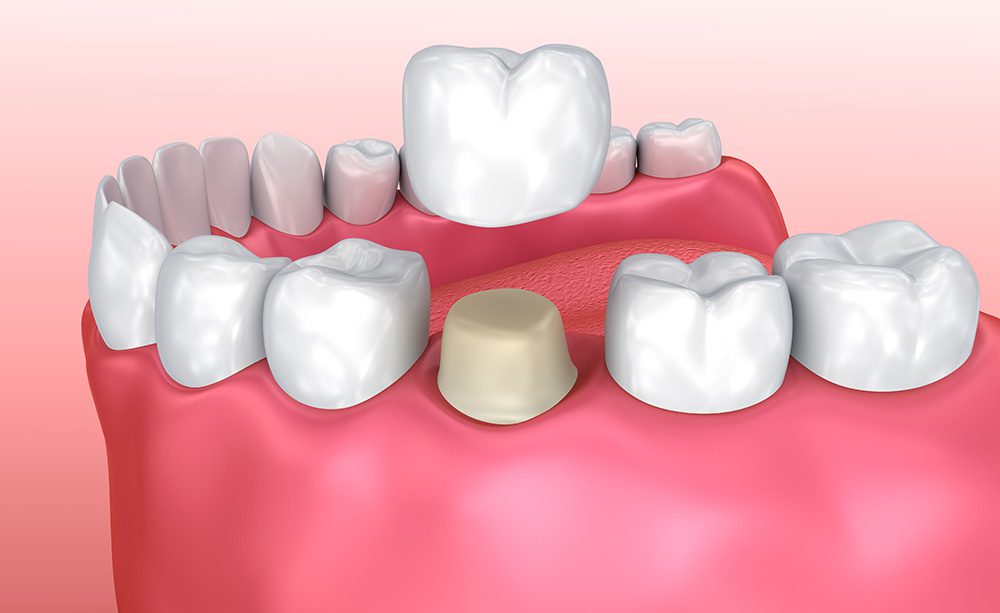 Dental model showing the placement of dental crown.