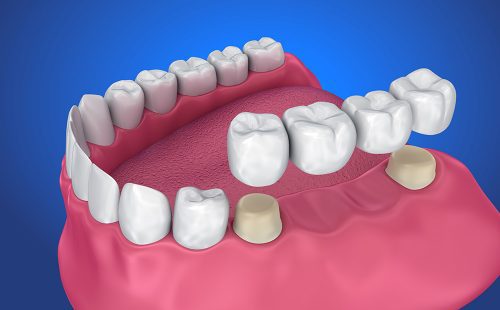 Model of mouth showing were dental bridge will go.