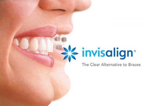 white background with two faces on left side, text that reads "Invisalign the clear alternative to braces"
