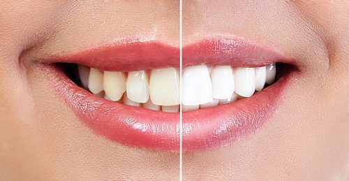 Photo of smile divided in half, showing before and after teeth bleaching.